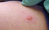La infección se produce por contacto directo con fluidos corporales o con las lesiones en la piel.