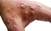Las lesiones en la piel conforman uno de los síntomas más comunes para identificar el contagio por viruela símica. 